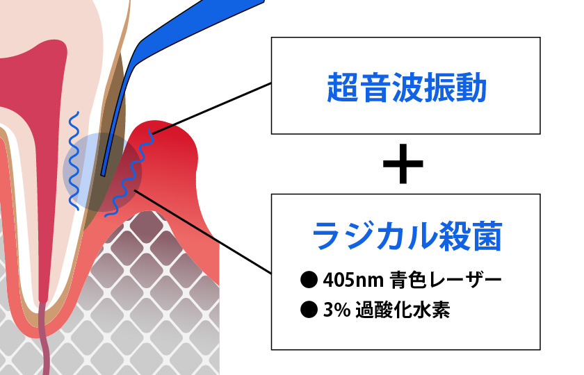 超音波振動+ブルーラジカル